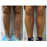Antes y después de implantes de pantorrilla en Memorial Göztepe Hospital – mejor contorno