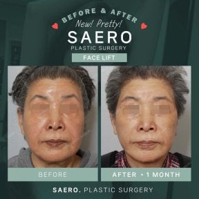 Результати до і після підтяжки обличчя в SAERO Plastic Surgery – помітне омолодження