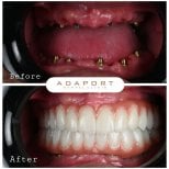 Результат до и после имплантации All-on-4 в Adaport Dental Clinic, полное восстановление улыбки