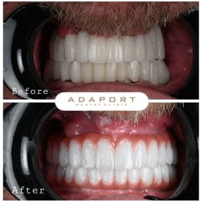 Результат до и после имплантации All-on-4 в Adaport Dental Clinic, улучшенная улыбка