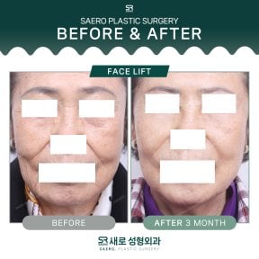 Resultados de lifting facial antes y después en SAERO Plastic Surgery, rejuvenecimiento visible