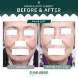 Resultados de lifting facial antes y después en SAERO Plastic Surgery, rejuvenecimiento visible