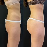 Before and after butt implants at Dr. Alexandro Aguilera - Plastic Surgery, enhanced contour result