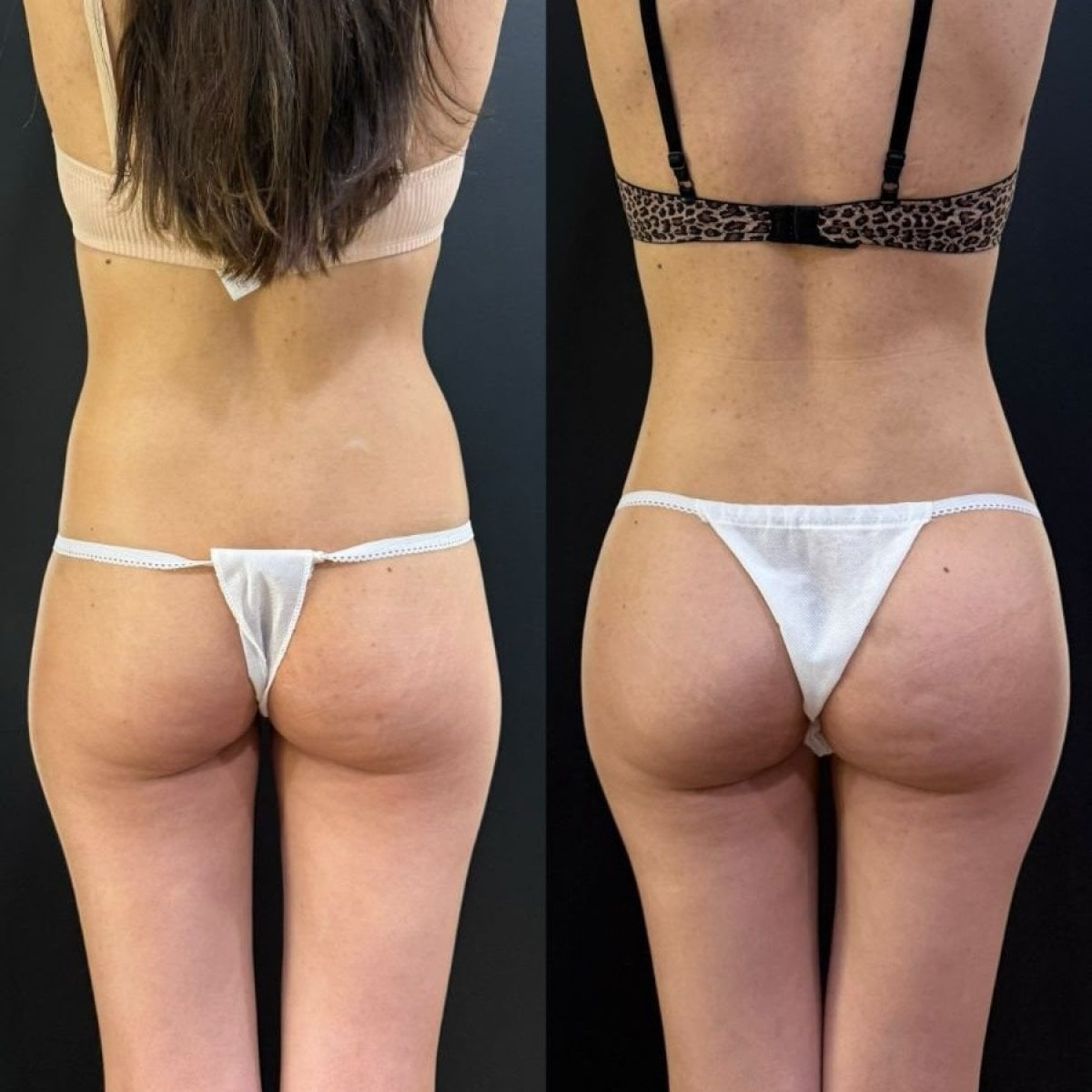 Antes y después de implantes de glúteos en Dr. Alexandro Aguilera - Plastic Surgery, mejor contorno