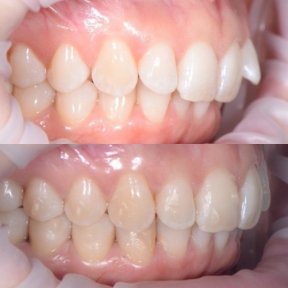 before-after photo braces