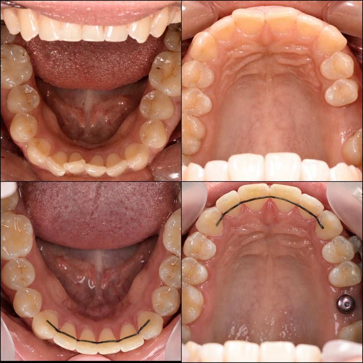 Resultados antes y después de ortodoncia en RIKOTA Dental Clinic – alineación y retenedores