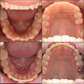 before-after photo braces