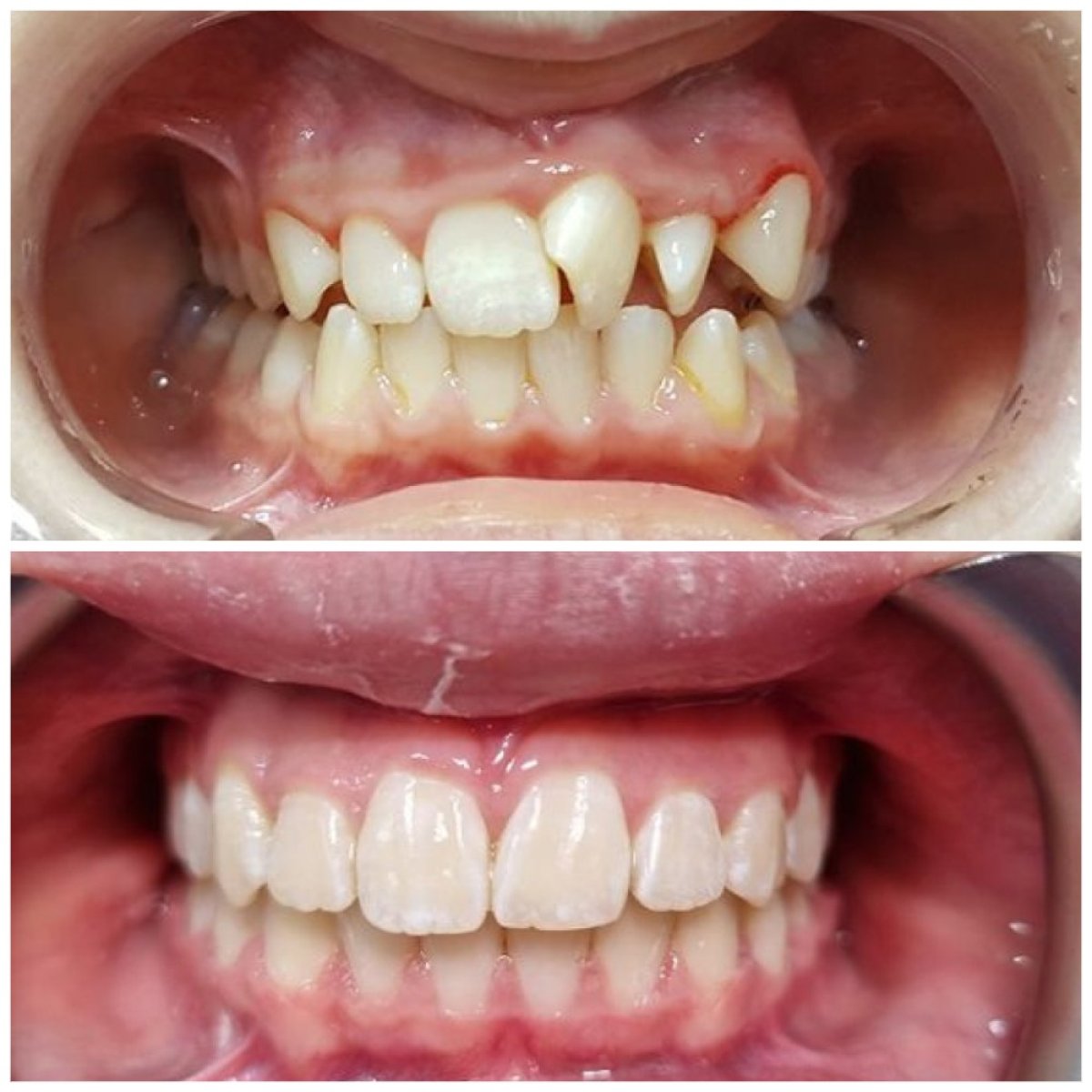 Resultados antes y después de ortodoncia en Dental Clinic Dynasty Stomatology Cracovia, alineación dental mejorada
