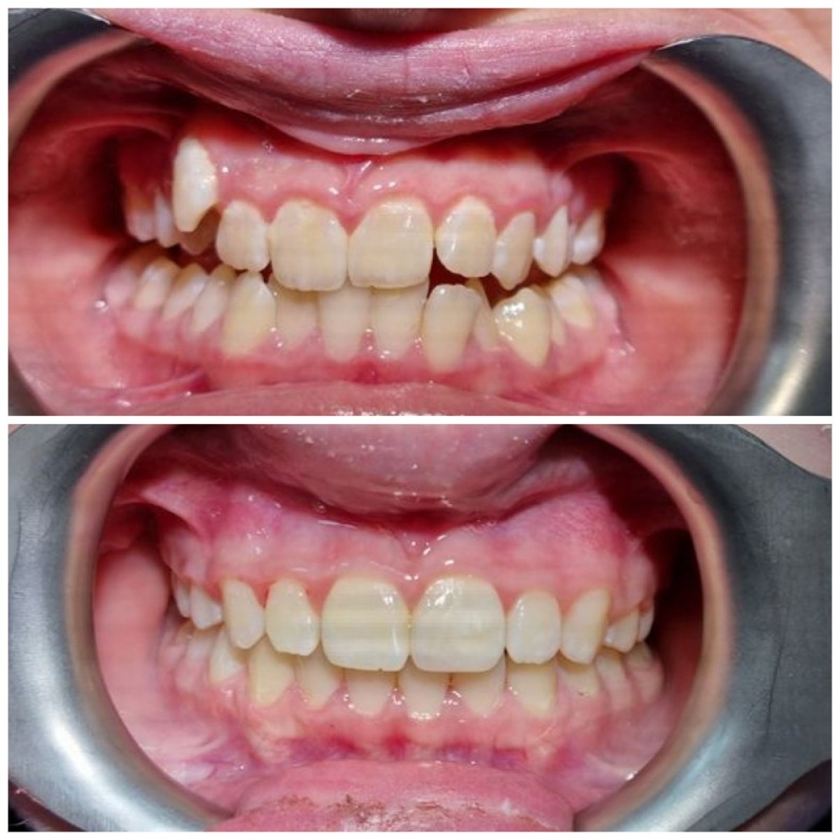 Resultados antes y después de ortodoncia en Dental Clinic Dynasty Stomatology Cracovia, dientes rectos