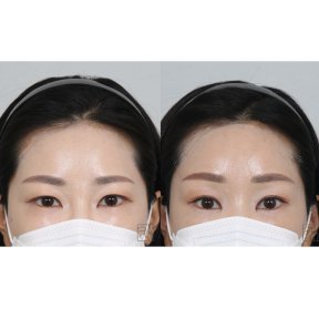 before-after photo lifting-lba