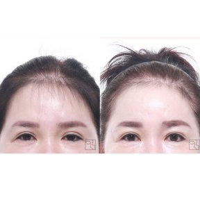 before-after photo lifting-lba
