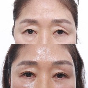 before-after photo lifting-lba