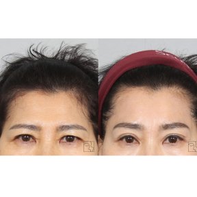 before-after photo lifting-lba