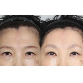 before-after photo lifting-lba