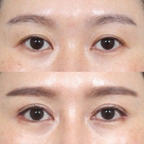 Before and after brow lift results at Клиника пластической хирургии INIQUÉ, lifted eyebrow contour