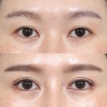 Before and after brow lift results at Клиника пластической хирургии INIQUÉ, lifted eyebrow contour