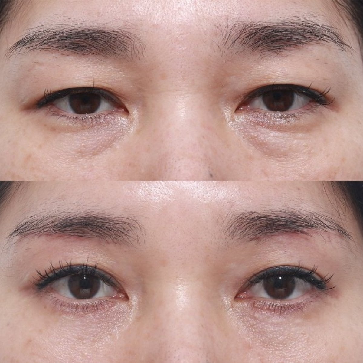 Resultados antes y después de lifting de cejas en Клиника INIQUÉ, rejuvenecimiento de párpados