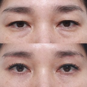 Before and after brow lift results at Клиника пластической хирургии INIQUÉ, eyelid rejuvenation