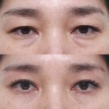 Before and after brow lift results at Клиника пластической хирургии INIQUÉ, eyelid rejuvenation