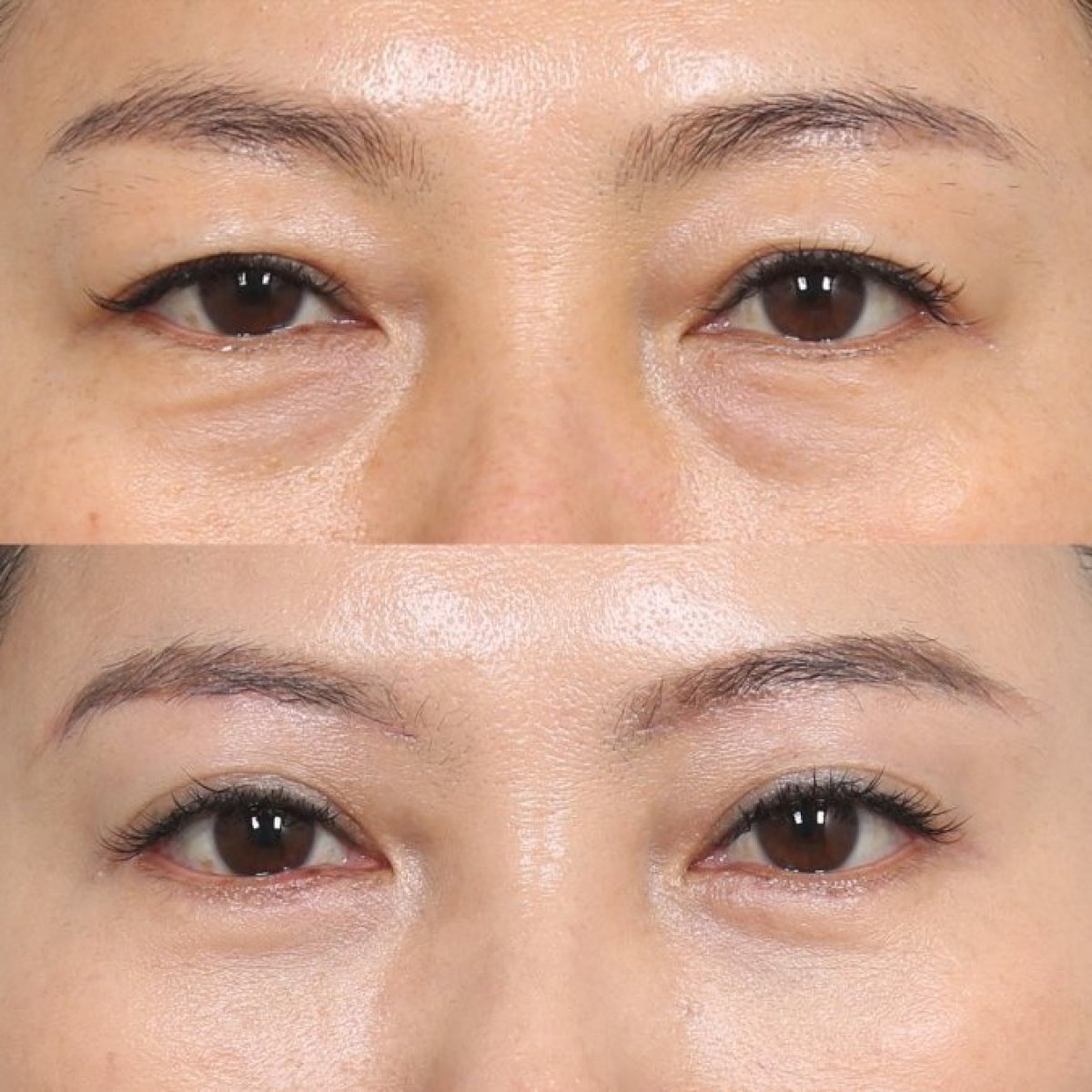 Resultados antes y después de lifting de cejas en Клиника INIQUÉ, rejuvenecimiento de párpados
