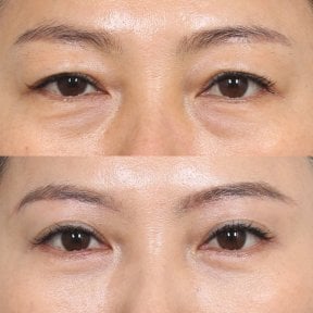 Before and after brow lift results at Клиника пластической хирургии INIQUÉ, eyelid rejuvenation