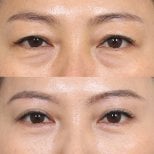 Before and after brow lift results at Клиника пластической хирургии INIQUÉ, eyelid rejuvenation