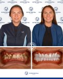 До и после виниров Hollywood Smile в Inter Dental Turkey – впечатляющее преображение улыбки