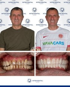 До и после Hollywood Smile в Inter Dental Turkey – заметные результаты преображения улыбки