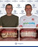 До и после Hollywood Smile в Inter Dental Turkey – заметные результаты преображения улыбки