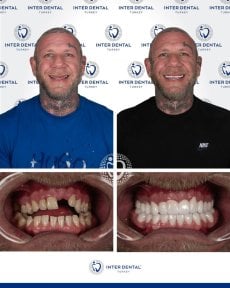 До и после Hollywood Smile в Inter Dental Turkey – результат полной трансформации улыбки