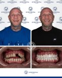 До и после Hollywood Smile в Inter Dental Turkey – результат полной трансформации улыбки