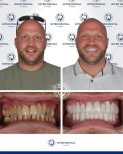 Результаты до и после Hollywood Smile в Inter Dental Turkey – полное преображение улыбки