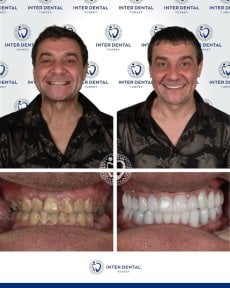 Результаты до и после Hollywood Smile в Inter Dental Turkey – полное преображение улыбки