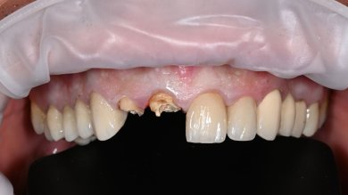 before-after photo installation-of-a-veneer