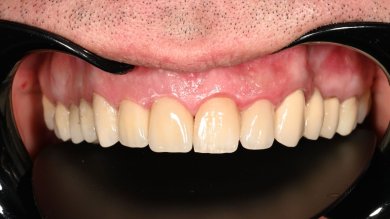 before-after photo installation-of-a-veneer