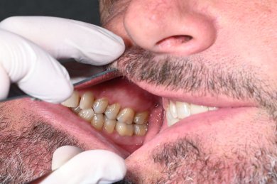 before-after photo installation-of-a-veneer