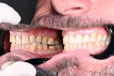 before-after photo installation-of-a-veneer