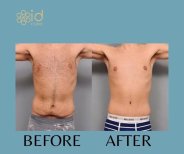Before and after tummy tuck results at ID Clinic Bangkok, improved abdominal contour