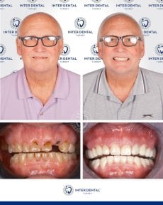 before-after photo zirconia-crown-installation