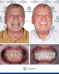 before-after photo zirconia-crown-installation