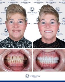 before-after photo zirconia-crown-installation