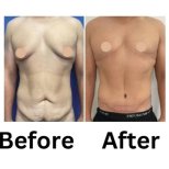 Before and after tummy tuck and liposuction results at ID Clinic Bangkok for body contouring