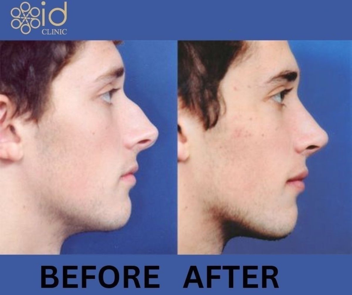 Resultados de rinoplastia antes y después en ID Clinic Bangkok, perfil nasal mejorado