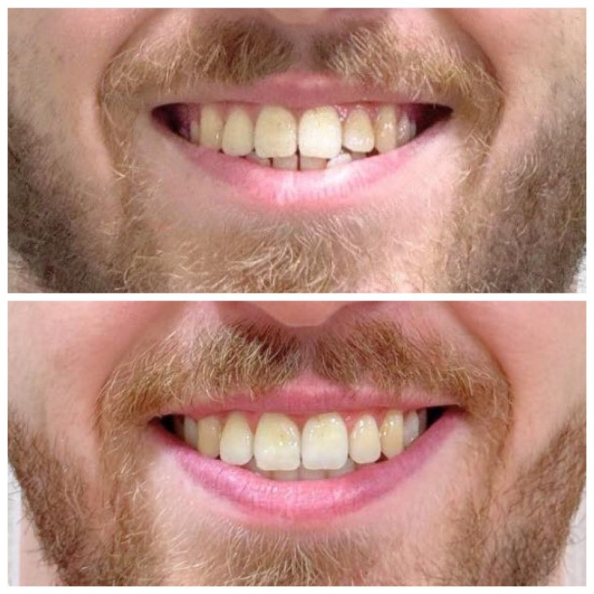 نتائج قبل وبعد تقويم Invisalign في عيادة Dentist at home، تشونبوري – أسنان أكثر استقامة