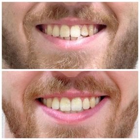 Результаты до и после Invisalign в Dentist at home Clinic, Чонбури – ровные зубы