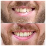 Результаты до и после Invisalign в Dentist at home Clinic, Чонбури – ровные зубы