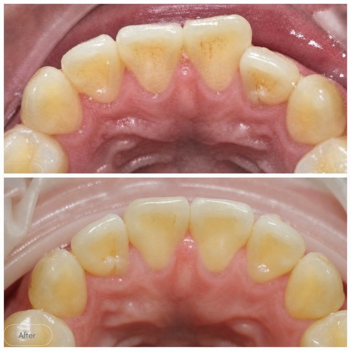 Resultados antes y después de Invisalign en Dentist at home Clinic, Chonburi, mejora de alineación dental