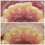 Результаты до и после Invisalign в Dentist at home Clinic, Chonburi, улучшение выравнивания зубов