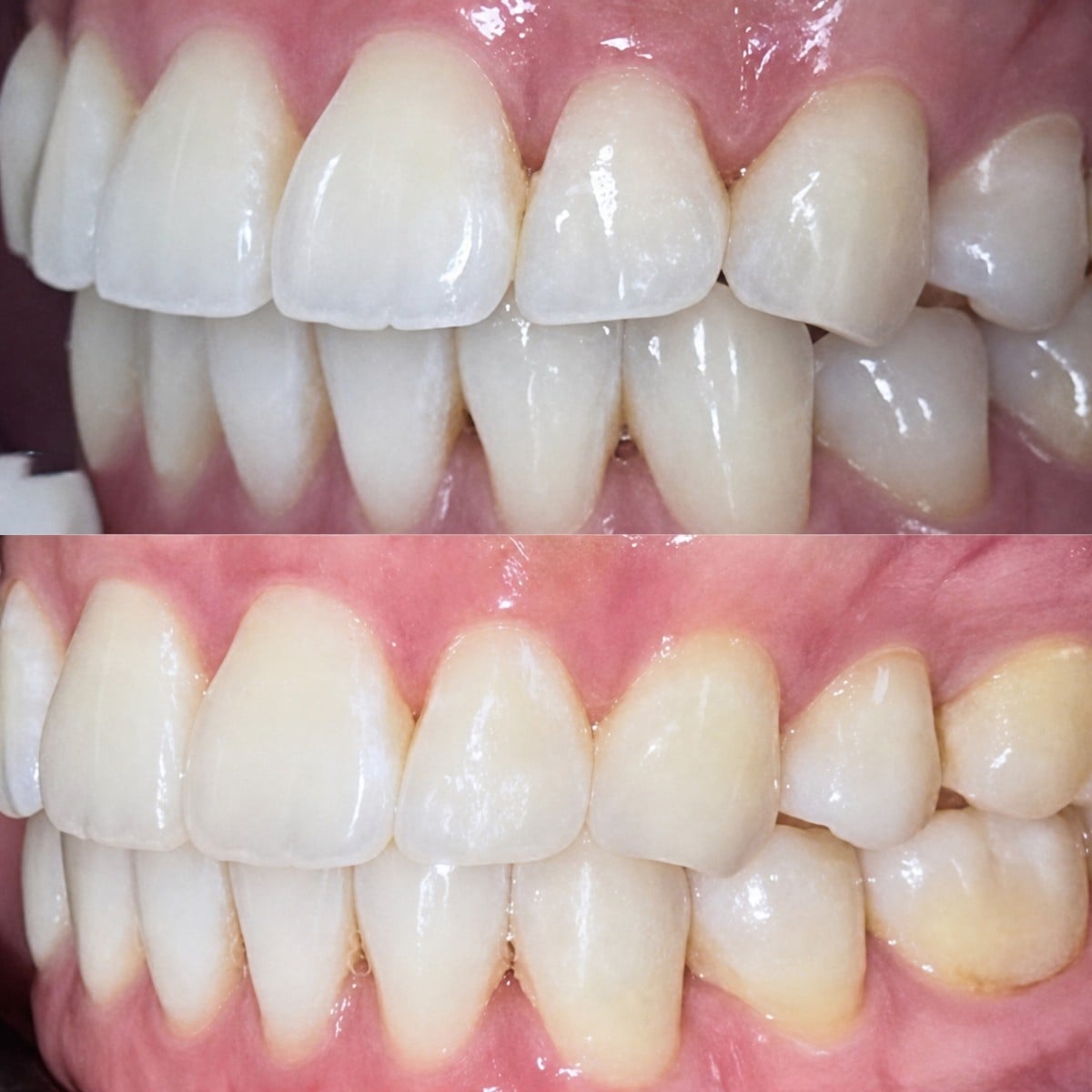 Resultados antes y después de Invisalign en Dentist at home Clinic, Chonburi – dientes alineados