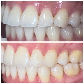 Результаты до и после Invisalign в Dentist at home Clinic, Чонбури – ровные зубы